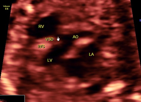 VSD IN A FETUS 1 | Looking Through a Transducer