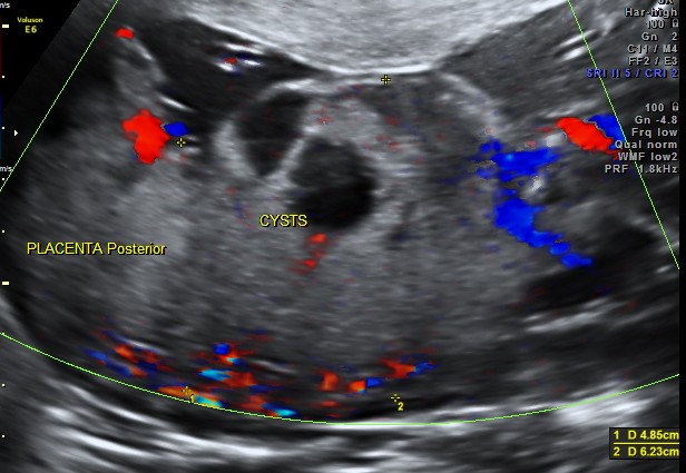 Placentomegaly with placental cysts