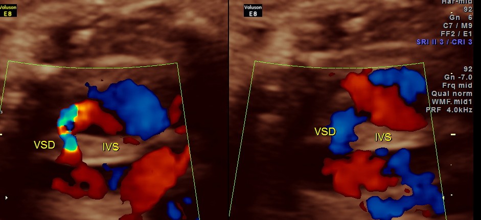 VSD IN A FETUS -FOLLOW UP FINDINGS | Looking Through a Transducer