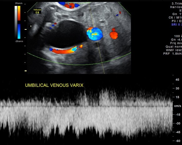 Vari X Umbilical Vein Varix Ultrasound