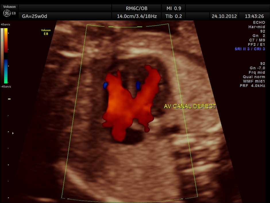 colour flow clearly demonstrating the atrio ventricular septal defect