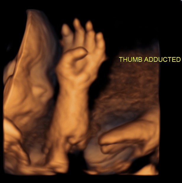 persistently adducted left thumb