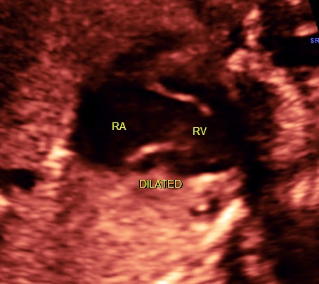 dilated RA AND RV with hypoplastic left heart