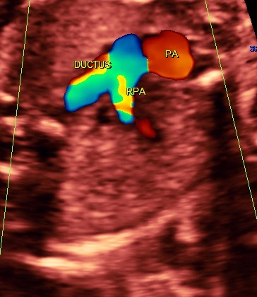 RV outflow tract with dilated Pulmonary trunk dividing into the Rt Pulm artery and the ductus seen. Aorta is not made out. ; SVC is seen 
