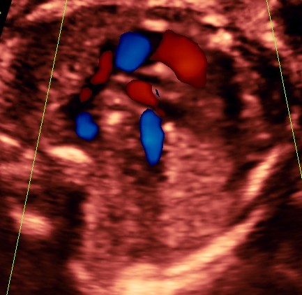 another view of RVOT , PA with the divisions ; Aortic flow not made out clearly