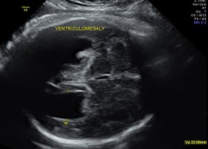 dilated occipital horns -colpocephaly