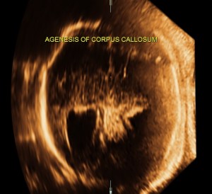 demonstration of both medial and lateral ventricular walls at a level where the single periventricular line is normally demonstrated