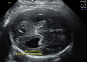 cavum septum pellucidum is not made out clearly