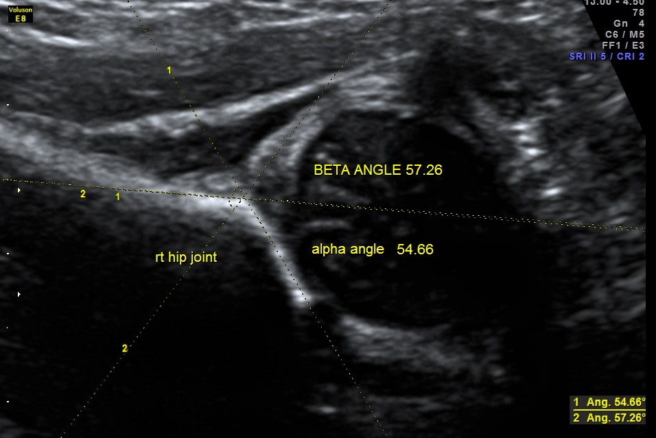 Developmental Dysplasia of HIP (D.D.H.) | Looking Through a Transducer