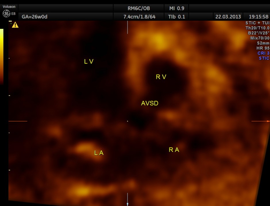STIC image showing A V SEPTAL DEFECT
