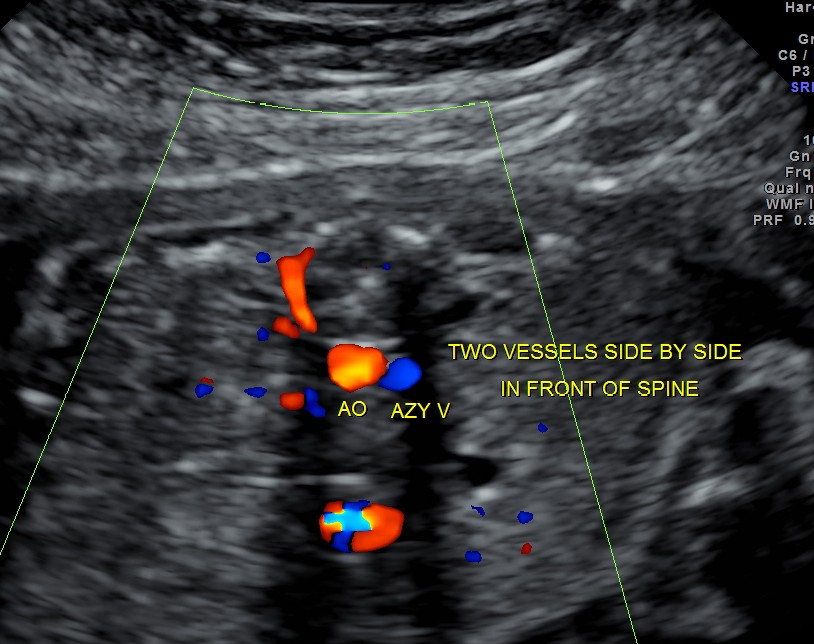 double vessel sign seen in front of spinetwo splenic arteries are seen running backwards - indicating polysplenia