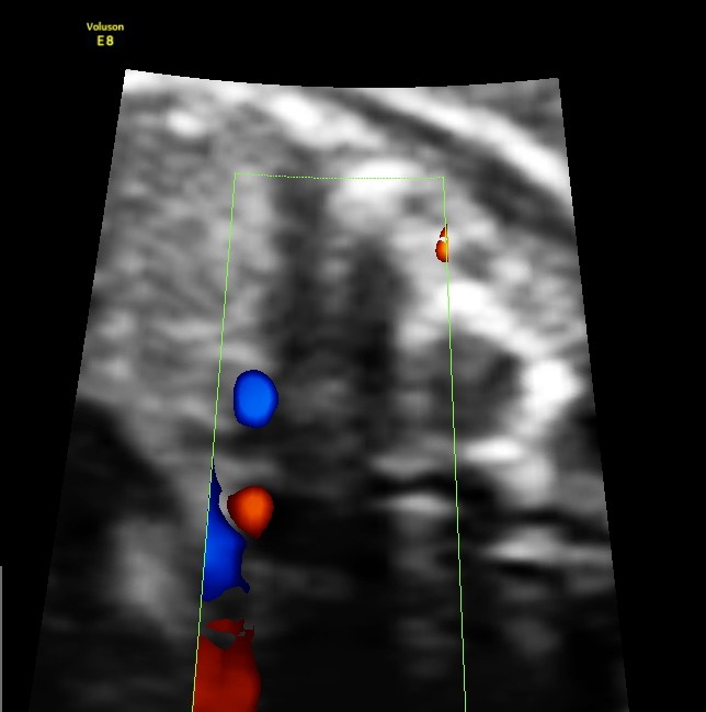 zoom of double vessel behind the heart