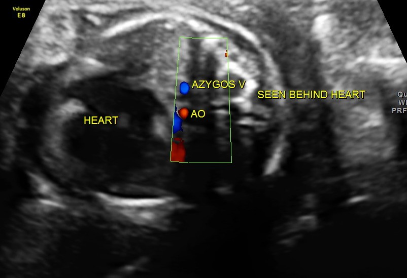 double vessel sign seen behind the heart