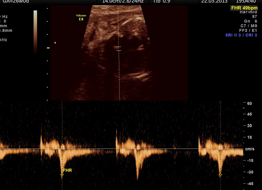 this shows severe bradycardia