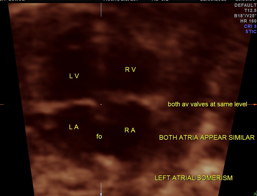 A V VALVES AT SAME LEVEL 