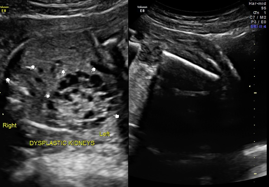 renal dysplasia - left is grossly enlarged , right is mildly enlarged