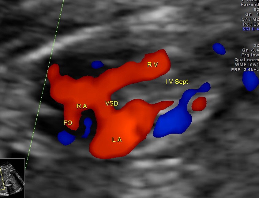 apart from foramen ovale flow , VSD is seen