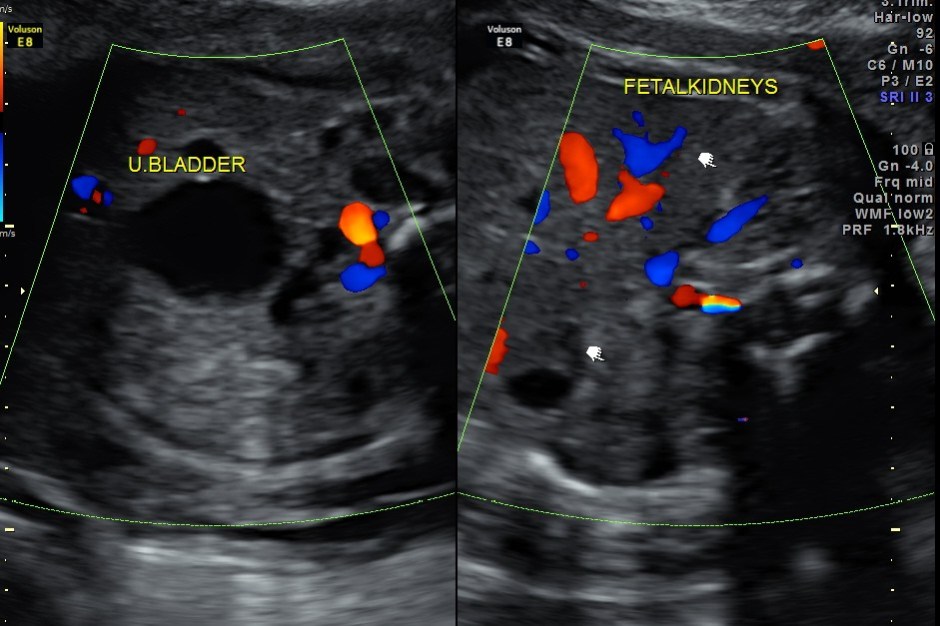 BIL HYDRO  URETERO NEPHROSIS_13