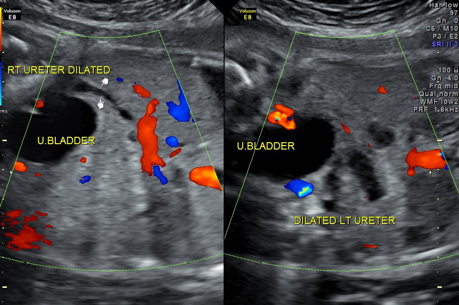 dilated ureters are seen