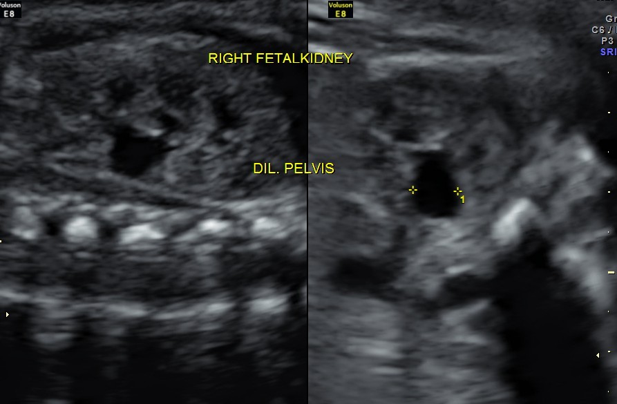 rt renal dilated pelvis