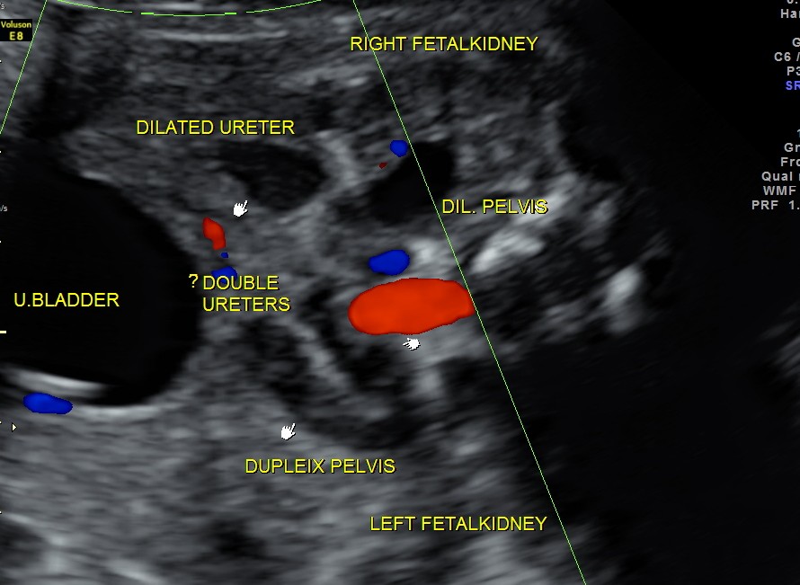 BIL HYDRO  URETERO NEPHROSIS_17