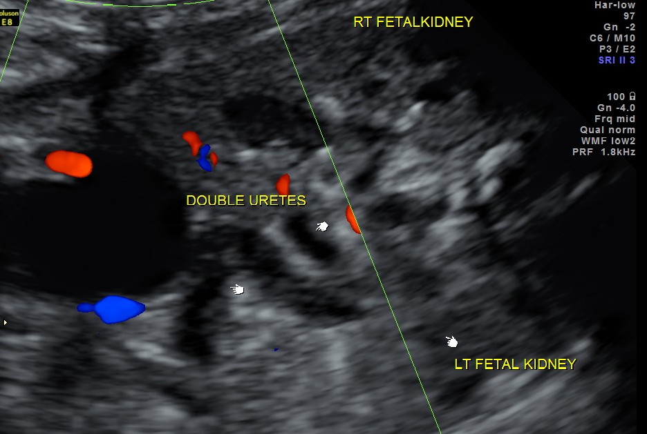 ? tortuous and kinked left ureter also looks like double ureters