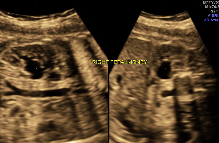 BIL HYDRO  URETERO NEPHROSIS_19