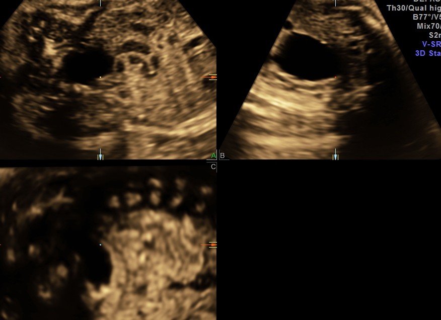 BIL HYDRO  URETERO NEPHROSIS_23