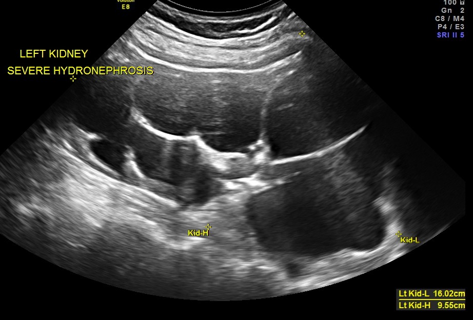 HYDRONEPHROSIS 3D _1