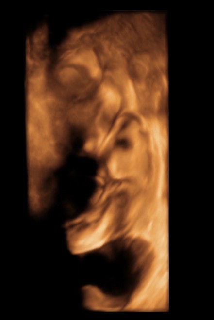HYDRONEPHROSIS 3D _3