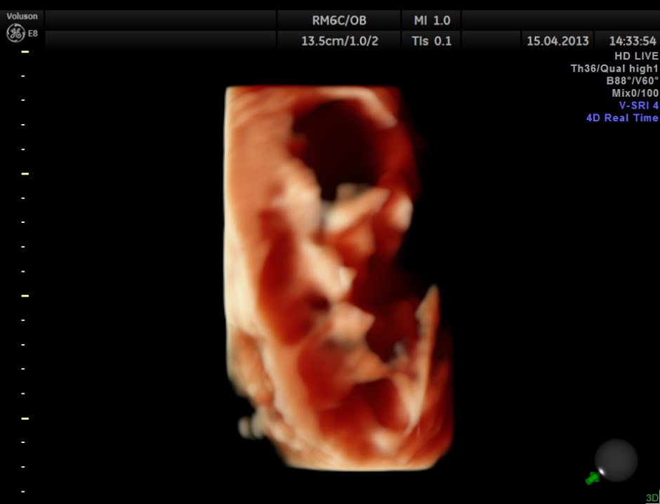 HYDRONEPHROSIS 3D _4