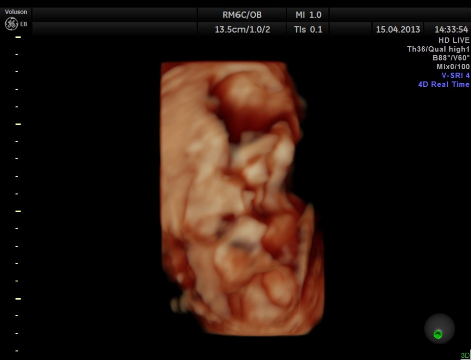 HYDRONEPHROSIS 3D _5