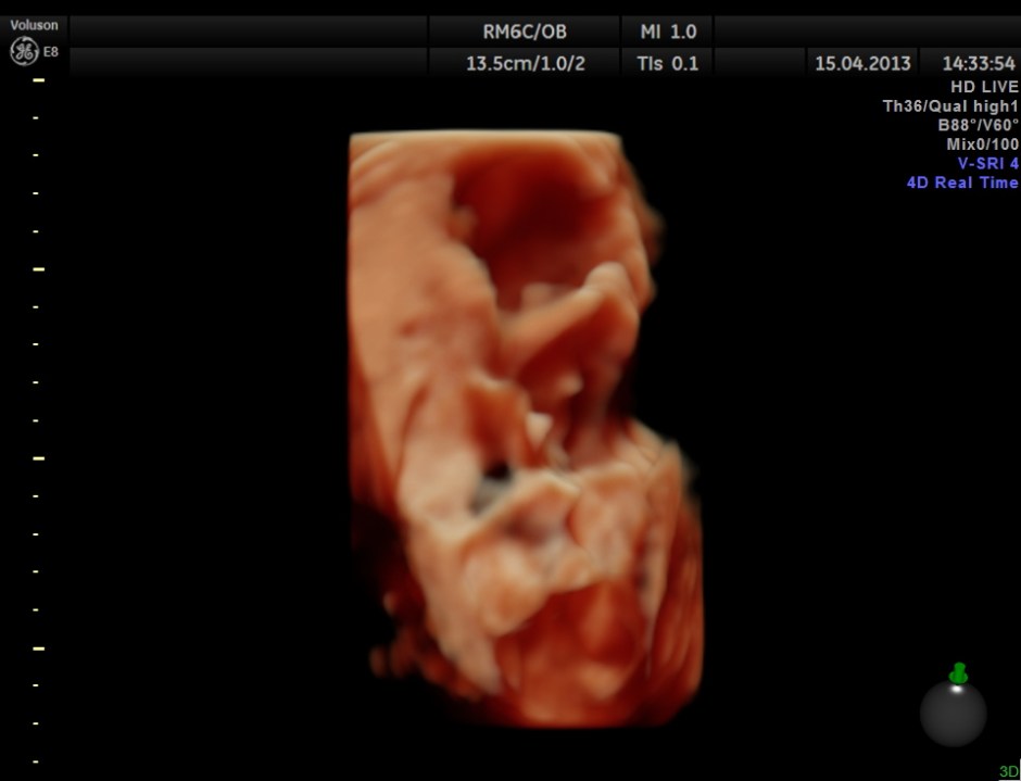 HYDRONEPHROSIS 3D _6