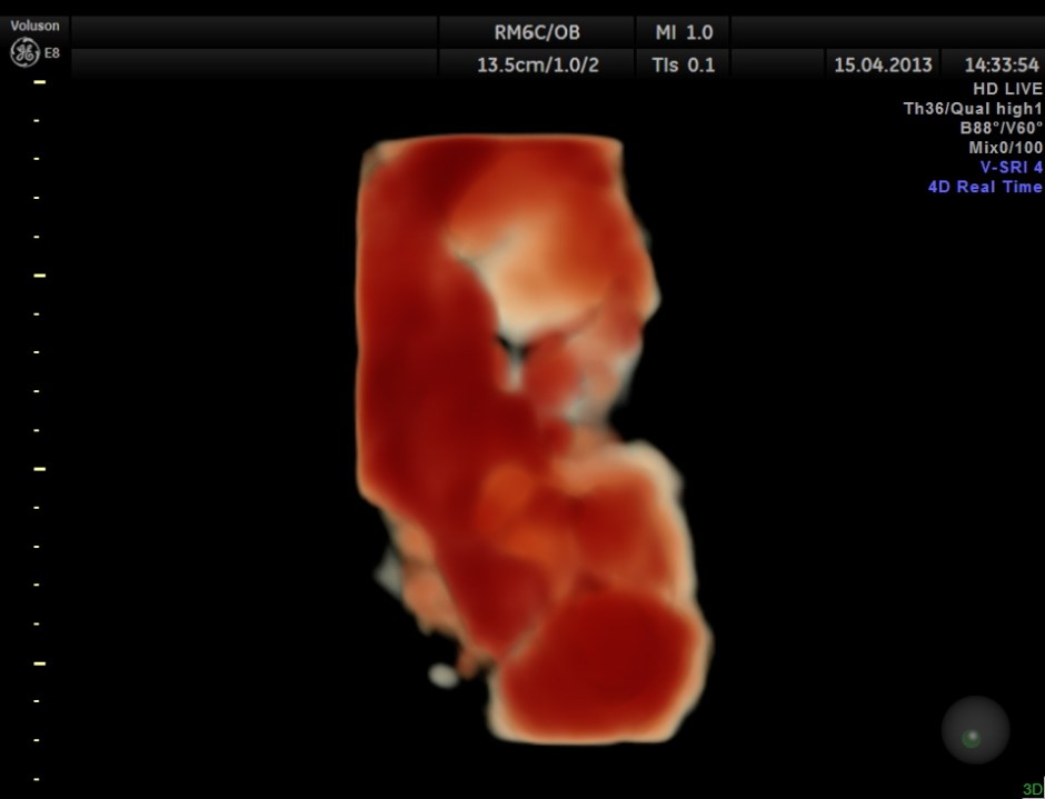 HYDRONEPHROSIS 3D _7