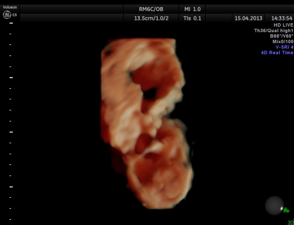 HYDRONEPHROSIS 3D _8