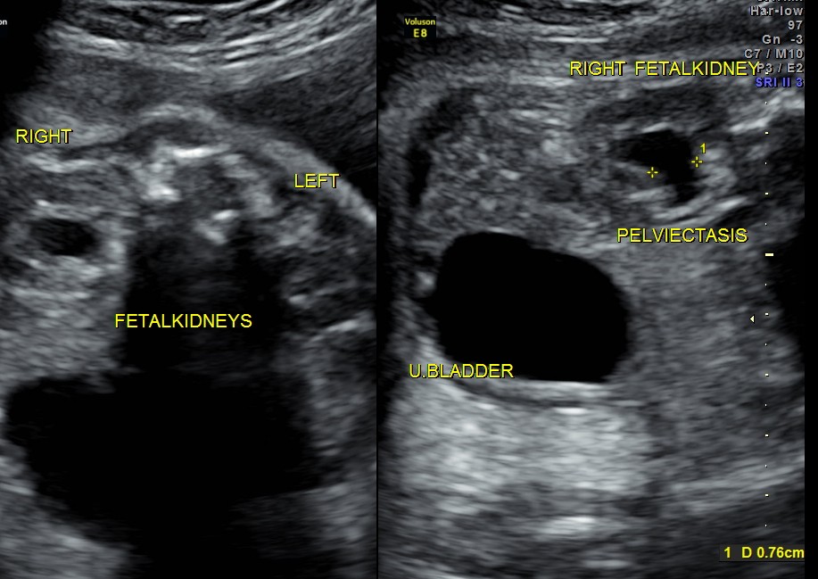 rt renal pelviectasis