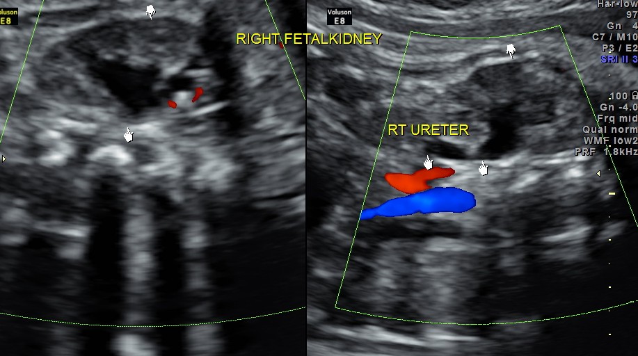 rt proximal ureter is also seen to be dilated