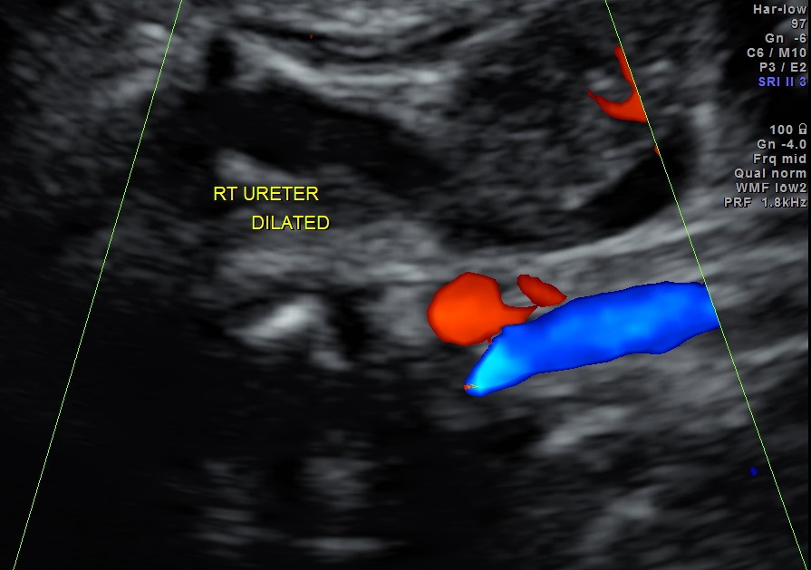 rt ureter is seen to be dilated through out