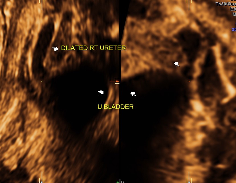 vesico ureteric junction 3 d