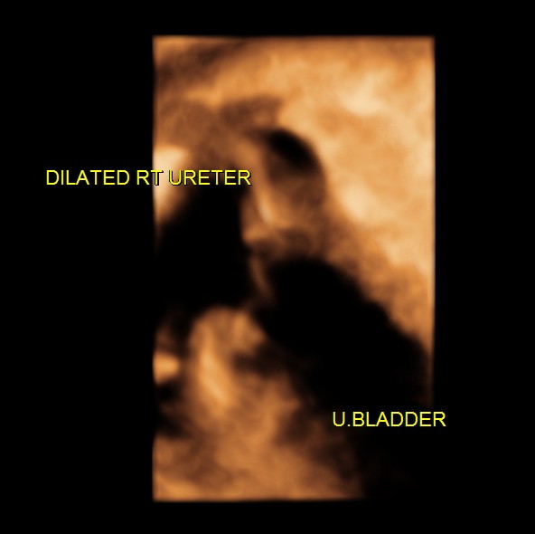 RT HYDRO URETERO NEPHROSIS_5
