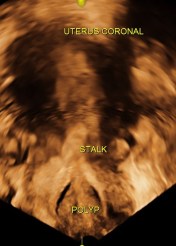 reconstructed image showing the stalk arising from endometrium and the polyp in the  cervix