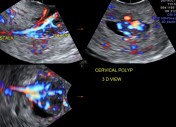 the multi planar 3 d image shows increased flow in the polyp and the stalk arising from the endometrium