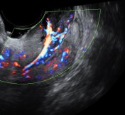 the vascular stalk is seen 