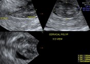 multi planar image showing the polyp