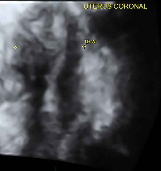 coronal view ( trans abdominal )