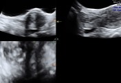 trans abdominal  multi planar view