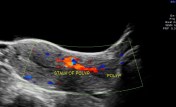 trans abdominal colour doppler showing  a long vascular stalk