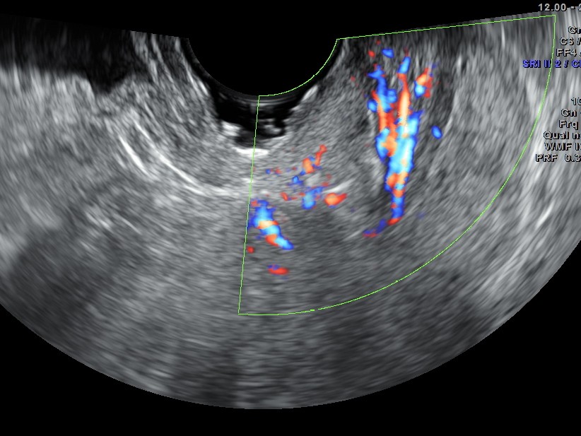 the increased vascularity of the polyp in the cervix can be seen