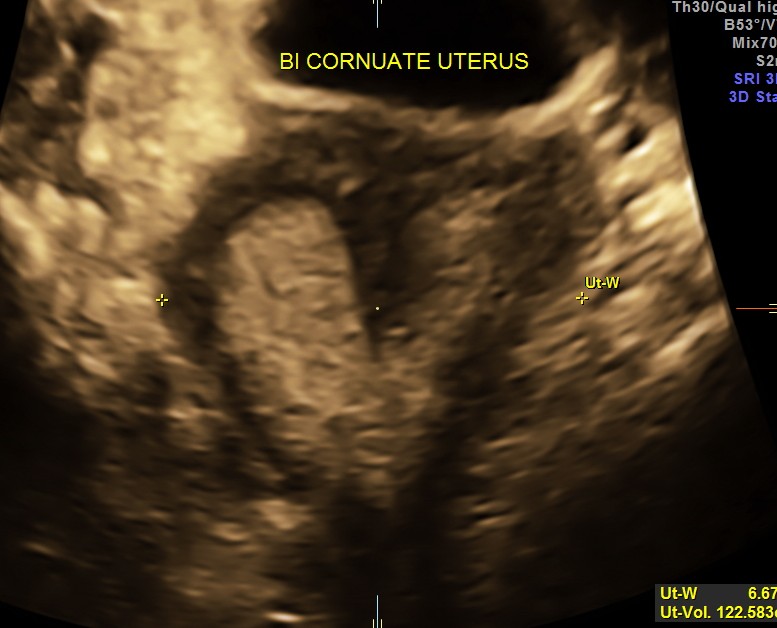 CHOLEDOCHAL CYST CH_16