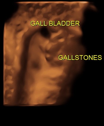 3 d of gallbladder with gallstones